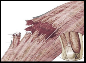 foto lesiones musculares 1
